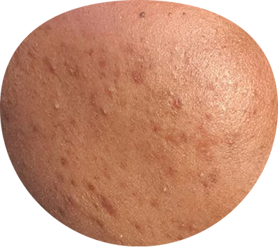 Acne Scars & Blemishes