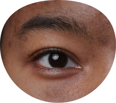 Dark Spots & Hyperpigmentation
